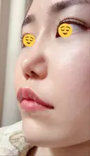 ボトックス（エラ・小顔） / ヒアルロン酸注入（頬） 高崎TAクリニック DAY 18 サムネイル用