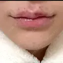 ボトックス（あご） / ヒアルロン酸注入（唇） / ボトックス（口角） ルラ美容クリニック 大阪本院 DAY 2 サムネイル用