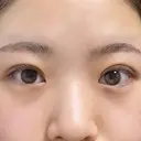 目頭切開 東京エビスクリニック DAY 54 サムネイル用