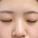 目頭切開 東京エビスクリニック DAY 54 サムネイル用