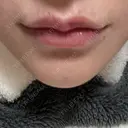 ボトックス（あご） / ヒアルロン酸注入（唇） / ボトックス（口角） ルラ美容クリニック 大阪本院 DAY 3 サムネイル用