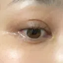 二重埋没 聖心美容クリニック 札幌院 DAY 13 サムネイル用