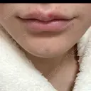 ボトックス（あご） / ヒアルロン酸注入（唇） / ボトックス（口角） ルラ美容クリニック 大阪本院 DAY 4 サムネイル用