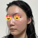 ハイフ（顔） / イオン導入 湘南美容クリニック 新宿南口院 DAY 8 サムネイル用