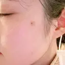 ピコスポット 日比谷セントラルクリニック DAY 0 サムネイル用