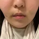 糸リフト / バッカルファット除去 / 脂肪吸引（顔） EMMA CLINIC（エマクリニック） DAY 3 サムネイル用