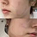 その他（輪郭） パールスキンクリニック天神 DAY 18 サムネイル用