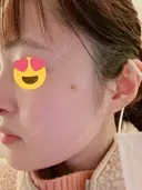 ピコスポット 日比谷セントラルクリニック DAY 1 サムネイル用
