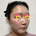 ハイフ（顔） / イオン導入 湘南美容クリニック 新宿南口院 DAY 10 サムネイル用