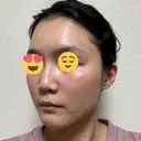 ハイフ（顔） / イオン導入 湘南美容クリニック 新宿南口院 DAY 10 サムネイル用