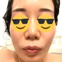 ハイフ（顔） / ピコレーザートーニング（美白・肝斑） / フラクショナルレーザー（毛穴・ニキビ跡） TRUE DESIGN CLINIC AFTER サムネイル用