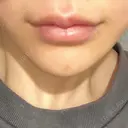 ボトックス（あご） / ヒアルロン酸注入（唇） / ボトックス（口角） ルラ美容クリニック 大阪本院 DAY 8 サムネイル用