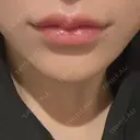 ボトックス（あご） / ヒアルロン酸注入（唇） / ボトックス（口角） ルラ美容クリニック 大阪本院 AFTER サムネイル用