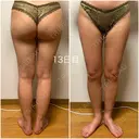 脂肪吸引（脚） / 豊胸（脂肪注入） GAYA body design clinic DAY 13 サムネイル用
