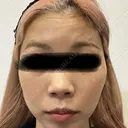 ボトックス（あご） / ボトックス（エラ・小顔） / ボトックス（口角） / ボトックス（眉間） / ボトックス（額） M'sクリニック【エムズクリニック】 DAY 36 サムネイル用