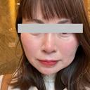 ヒアルロン酸注入（涙袋） / ボトックス（眉間） / ボトックス（目尻） ルラ美容クリニック 神戸院 AFTER サムネイル用