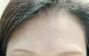 ボトックス（眉間） ルラ美容クリニック銀座院 AFTER サムネイル用