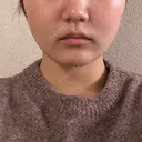 バッカルファット除去 / 脂肪吸引（顔） 湘南美容クリニック 京都院 AFTER サムネイル用