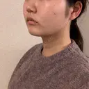 バッカルファット除去 / 脂肪吸引（顔） 湘南美容クリニック 京都院 DAY 167 サムネイル用