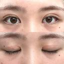 二重切開 つだ美容外科クリニック DAY 123 サムネイル用