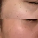 ルメッカ BIANCA表参道 AFTER サムネイル用