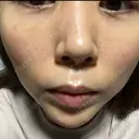 肌ヒアルロン酸注入（たるみ・シワ改善） BAO CLINIC 心斎橋院 AFTER サムネイル用