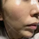 肌ヒアルロン酸注入（たるみ・シワ改善） BAO CLINIC 心斎橋院 DAY 40 サムネイル用