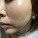 肌ヒアルロン酸注入（たるみ・シワ改善） BAO CLINIC 心斎橋院 DAY 40 サムネイル用