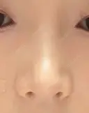 鼻尖形成（切開） / 軟骨移植 / 鼻修正 / 鼻柱下降・鼻唇角形成（猫手術） 東京シンデレラ美容外科 池袋院 DAY 17 サムネイル用