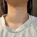 ハイフ（首） 湘南美容クリニック 新宿南口院 DAY 2 サムネイル用