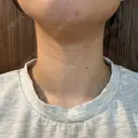 ハイフ（首） 湘南美容クリニック 新宿南口院 DAY 4 サムネイル用