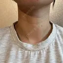 ハイフ（首） 湘南美容クリニック 新宿南口院 DAY 5 サムネイル用