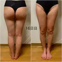 脂肪吸引（脚） / 豊胸（脂肪注入） GAYA body design clinic DAY 16 サムネイル用