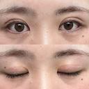 二重切開 つだ美容外科クリニック DAY 124 サムネイル用