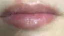 口唇縮小術 高須クリニック 大阪院 DAY 28 サムネイル用