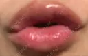 口唇縮小術 高須クリニック 大阪院 DAY 28 サムネイル用
