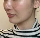 脂肪吸引注射（顔） ziz CLINIC DAY 16 サムネイル用