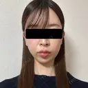 糸リフト / 脂肪吸引（顔） / ヒアルロン酸注入（あご） / ヒアルロン酸注入（こめかみ） BLINC CLINIC （ブリンク クリニック） AFTER サムネイル用