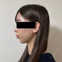 糸リフト / 脂肪吸引（顔） / ヒアルロン酸注入（あご） / ヒアルロン酸注入（こめかみ） BLINC CLINIC （ブリンク クリニック） DAY 26 サムネイル用