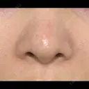 毛穴洗浄（ハイドラフェイシャルなど） 代官山ウィメンズクリニック DAY 2 サムネイル用