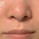 毛穴洗浄（ハイドラフェイシャルなど） 代官山ウィメンズクリニック DAY 5 サムネイル用