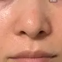 毛穴洗浄（ハイドラフェイシャルなど） 代官山ウィメンズクリニック DAY 6 サムネイル用