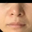 毛穴洗浄（ハイドラフェイシャルなど） 代官山ウィメンズクリニック DAY 7 サムネイル用