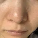 毛穴洗浄（ハイドラフェイシャルなど） 代官山ウィメンズクリニック DAY 8 サムネイル用