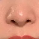 毛穴洗浄（ハイドラフェイシャルなど） 代官山ウィメンズクリニック DAY 9 サムネイル用