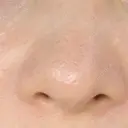 毛穴洗浄（ハイドラフェイシャルなど） 代官山ウィメンズクリニック AFTER サムネイル用