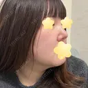 隆鼻術 / 鼻尖形成（切開） / 軟骨移植 エースクリニック 名古屋院 DAY 186 サムネイル用