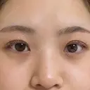 目頭切開 東京エビスクリニック AFTER サムネイル用