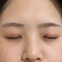 目頭切開 東京エビスクリニック DAY 72 サムネイル用