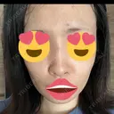 ヒアルロン酸注入（鼻） フィラークリニック 新宿院 AFTER サムネイル用